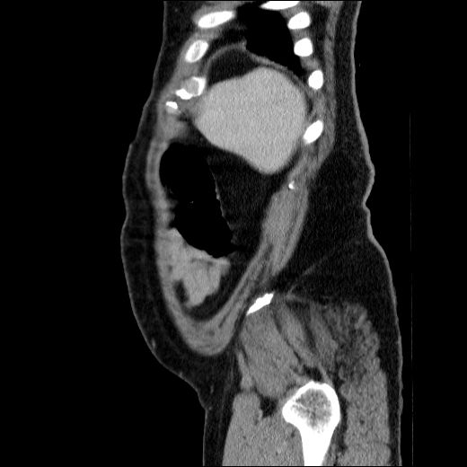 Obstructing ureteric calculus (Radiopaedia 49281-54373 C 17).jpg