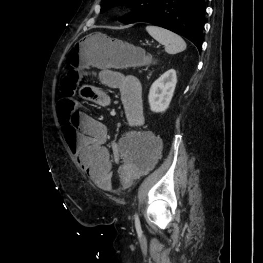 Obstructive colonic diverticular stricture (Radiopaedia 81085-94675 C 169).jpg
