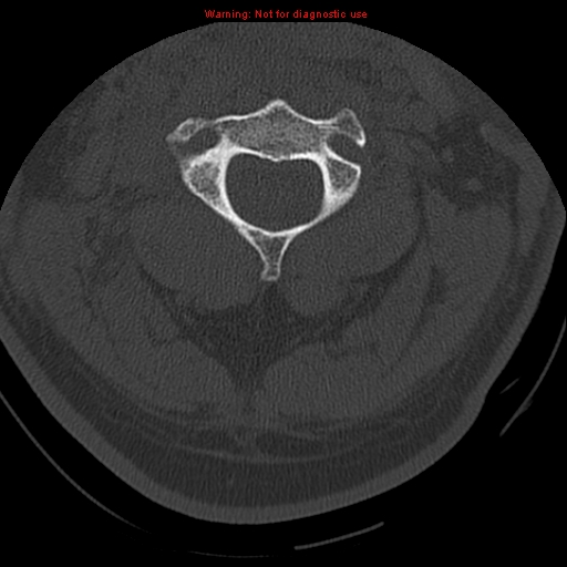 File:Occipital condyle fracture (Radiopaedia 18366-18208 Axial bone window 26).jpg