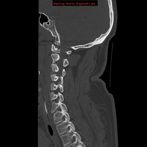 File:Occipital condyle fracture (Radiopaedia 18366-18208 Sagittal bone window 24).jpg