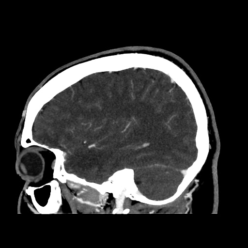 Occipital extradural hematoma simulating venous sinus thrombosis (Radiopaedia 46514-50964 D 57).jpg