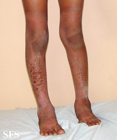 File:Pellagra (Dermatology Atlas 34).jpg