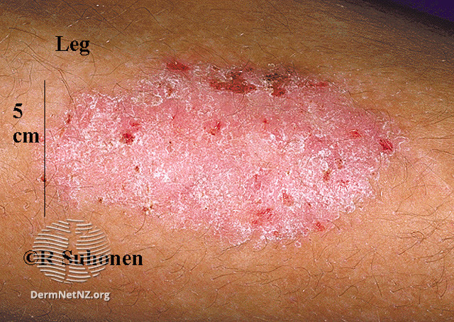 File:(DermNet NZ dermatitis-lichen-simplex-3123).jpg