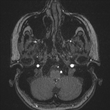 A1 segment hypoplasia (Radiopaedia 83365-97781 Axial TOF MRA 9).jpg