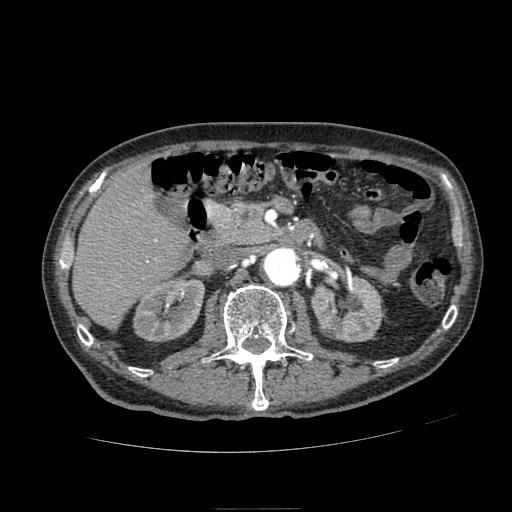 Abdominal aortic aneurysm (Radiopaedia 13341-13340 Axial C+ arterial phase 72).jpg