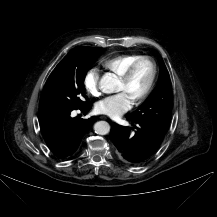 Abdominal aortic aneurysm (Radiopaedia 25855-26001 Axial C+ arterial phase 3).jpg