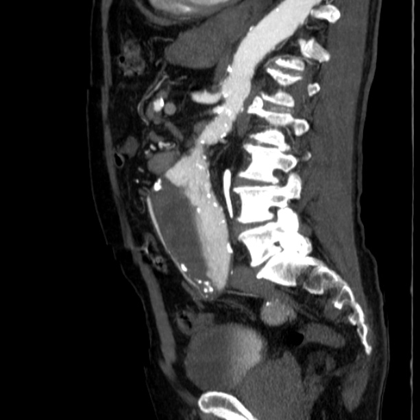 Abdominal aortic aneurysm (Radiopaedia 29248-29660 Sagittal C+ arterial phase 32).jpg