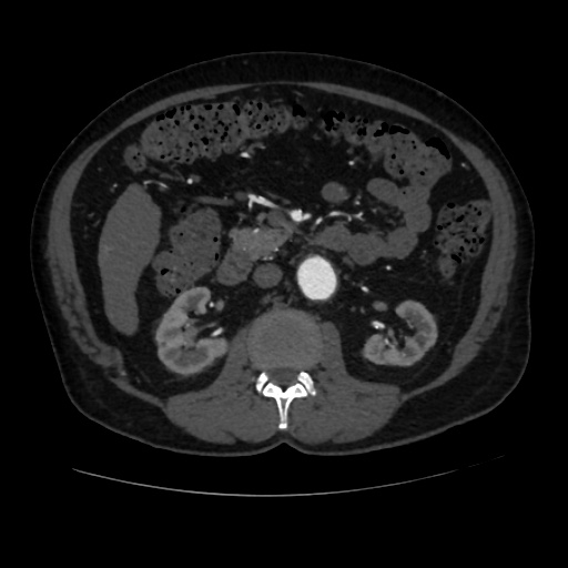 File:Abdominal aortic aneurysm (Radiopaedia 57318-64259 Axial C+ arterial phase 31).jpg