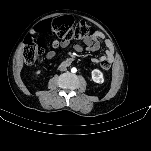 File:Abdominal aortic aneurysm (Radiopaedia 67117-76452 Axial C+ arterial phase 70).jpg