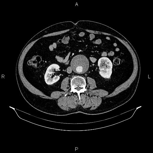 Abdominal aortic aneurysm (Radiopaedia 83094-97462 Axial renal cortical phase 103).jpg