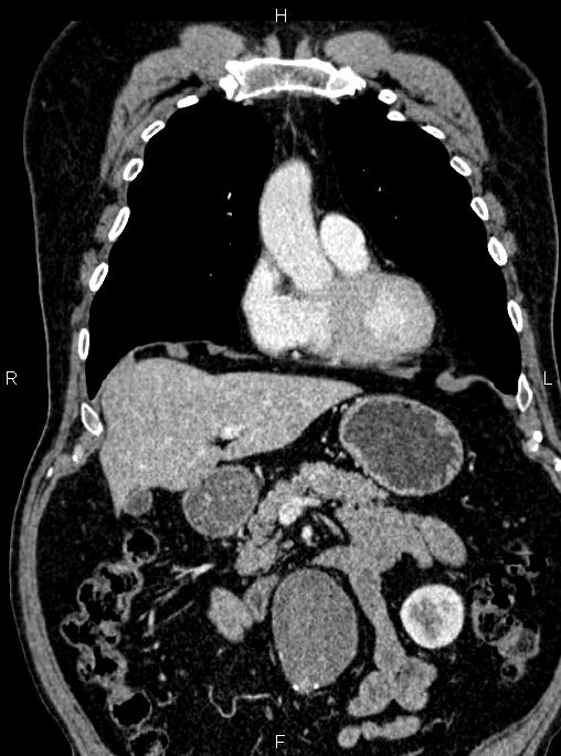 Abdominal aortic aneurysm (Radiopaedia 83094-97462 Coronal renal cortical phase 37).jpg