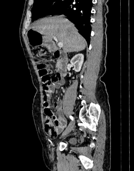 Abdominal aortic aneurysm (Radiopaedia 83581-98689 Sagittal C+ arterial phase 12).jpg