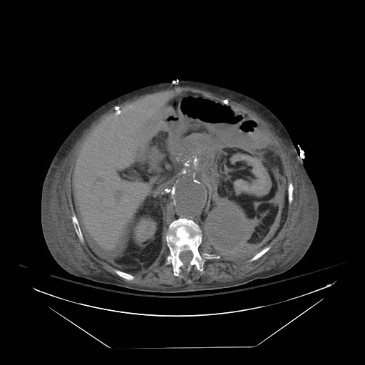 Abdominal aortic aneurysm - impending rupture (Radiopaedia 19233-19247 Axial non-contrast 65).jpg