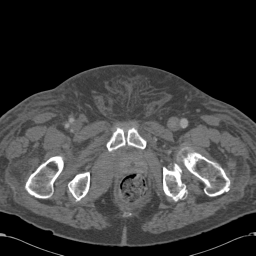 Abdominal hematoma (Radiopaedia 33614-34715 Axial C+ portal venous phase 135).png