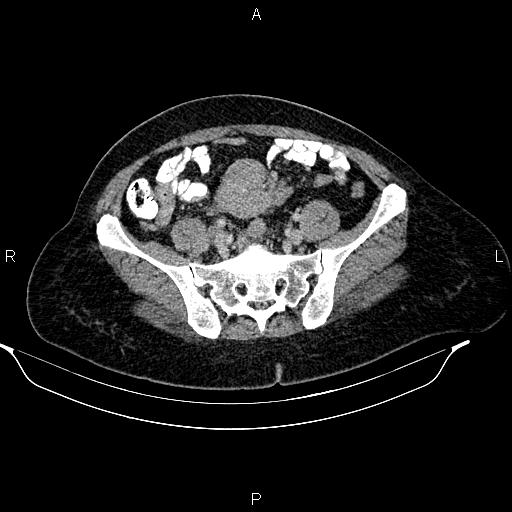 Abdominal lymphoma with sandwich sign (Radiopaedia 84378-99704 Axial C+ portal venous phase 43).jpg