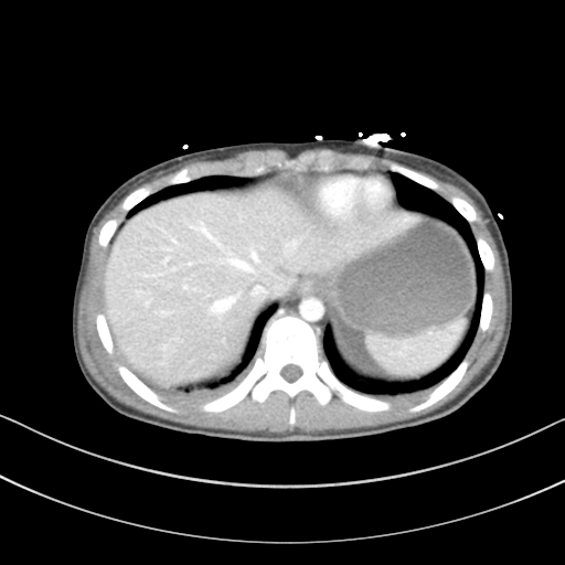 Abdominal multi-trauma - devascularised kidney and liver, spleen and pancreatic lacerations (Radiopaedia 34984-36486 Axial C+ portal venous phase 10).png