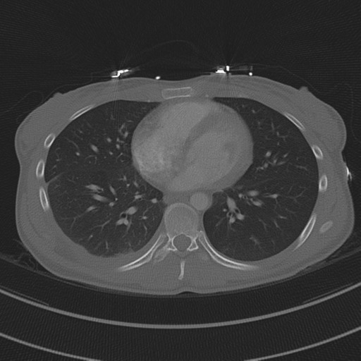 File:Abdominal multi-trauma - devascularised kidney and liver, spleen and pancreatic lacerations (Radiopaedia 34984-36486 I 54).png