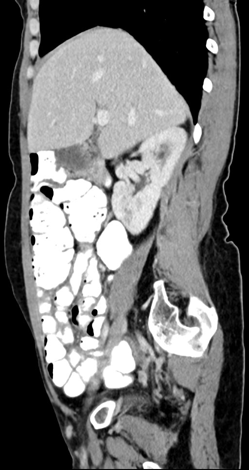 Abdominal wall and retroperitoneal tuberculosis (Radiopaedia 88137-104729 Sagittal C+ portal venous phase 98).jpg