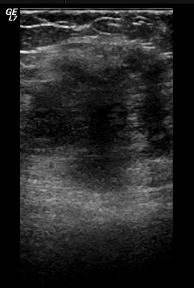 File:Abdominal wall endometriosis (Radiopaedia 25723-25886 A 3).jpg