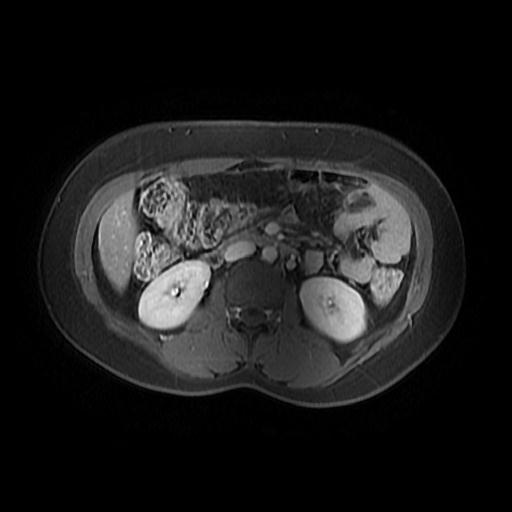 File:Abdominal wall endometriosis (Radiopaedia 83702-98847 Axial T1 C+ fat sat 3).jpg