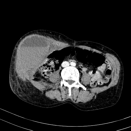 Abdominal wall hematoma with active bleeding (Radiopaedia 83915-99122 Axial contrast-enhanced CT 37).jpg