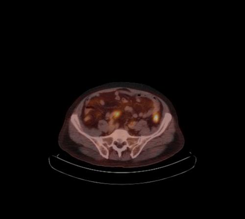 Abdominal wall metastasis from colorectal carcinoma (Radiopaedia 31016-31719 C 43).jpg