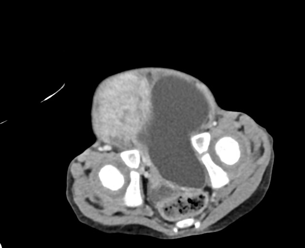 File:Abdominopelvic rhabdomyosarcoma (Radiopaedia 78356-90984 Axial C+ portal venous phase 145).jpg