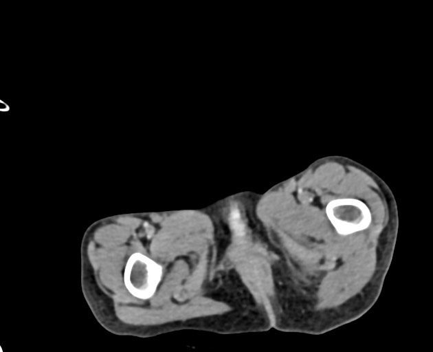 Abdominopelvic rhabdomyosarcoma (Radiopaedia 78356-90984 Axial C+ portal venous phase 164).jpg