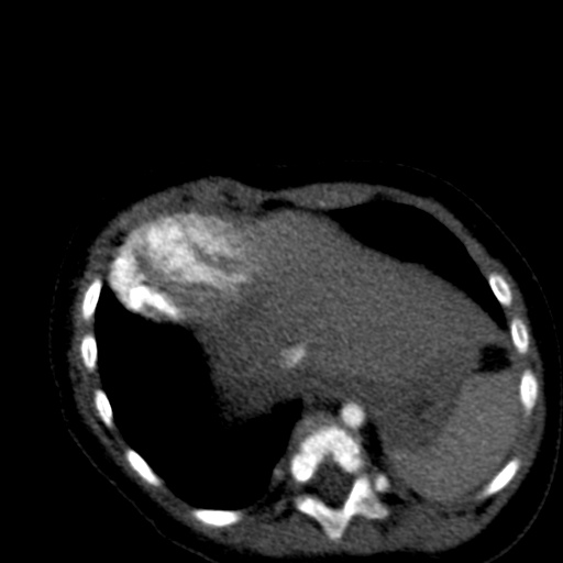Aberrant left pulmonary artery (pulmonary sling) (Radiopaedia 42323-45435 Axial C+ CTPA 37).jpg