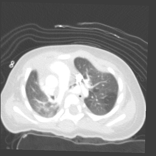 File:Aberrant left pulmonary artery (pulmonary sling) (Radiopaedia 42323-45435 Axial lung window 14).jpg