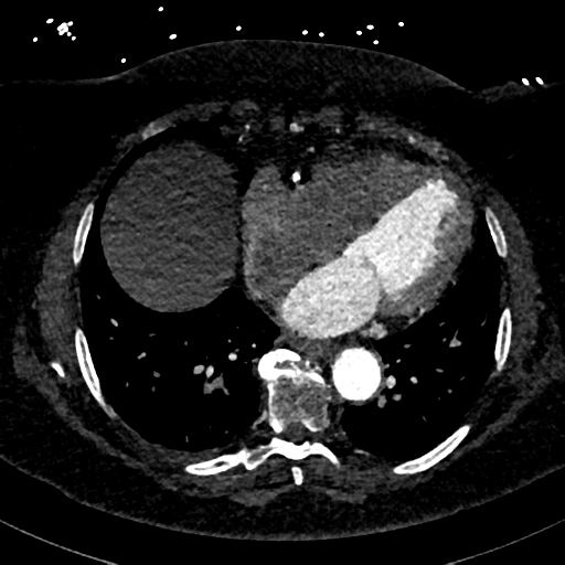 Aberrant right subclavian artery with Kommerell diverticulum (Radiopaedia 47982-52769 Axial C+ arterial phase 66).png