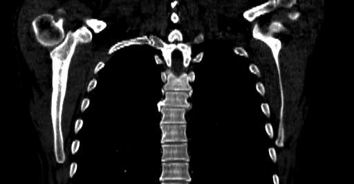 Accesory rib joint (Radiopaedia 71987-82452 Coronal bone window 41).jpg
