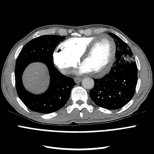Accessory left horizontal fissure with lingular pneumonia (Radiopaedia 53763-59843 Axial C+ CTPA 67).jpg