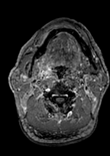 Accessory middle cerebral artery (Radiopaedia 73114-83828 Axial T1 C+ 287).jpg