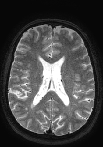 Accessory middle cerebral artery (Radiopaedia 73114-83828 Axial T2 36).jpg