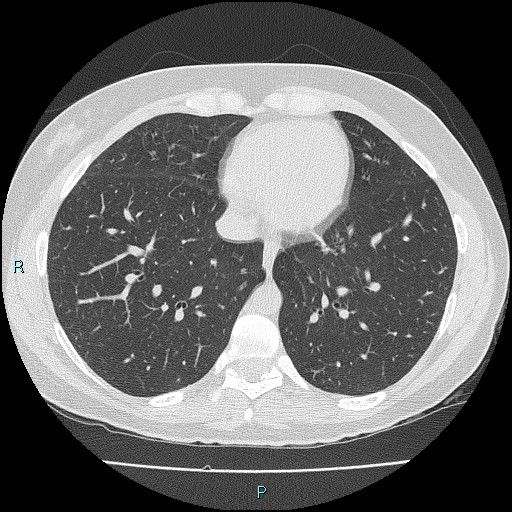 Accidental foreign body aspiration (seamstress needle) (Radiopaedia 77740-89983 Axial lung window 46).jpg