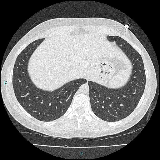 File:Accidental foreign body aspiration (seamstress needle) (Radiopaedia 77740-89983 Axial lung window 55).jpg