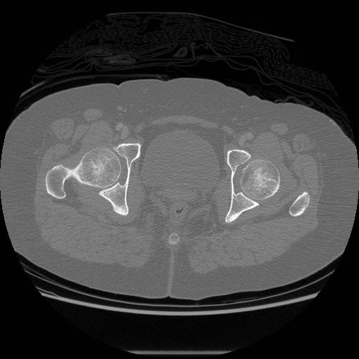 File:Acetabular fracture (Radiopaedia 13193-13212 Axial bone window 33).jpg