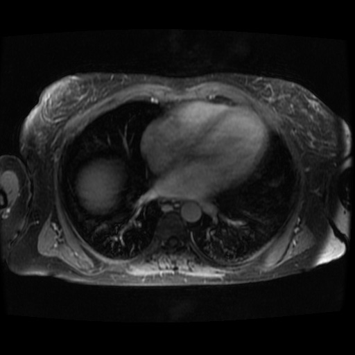 Acinar cell carcinoma of the pancreas (Radiopaedia 75442-86668 Axial T1 C+ fat sat 146).jpg