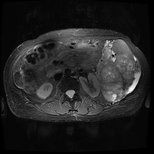 Acinar cell carcinoma of the pancreas (Radiopaedia 75442-86668 Axial T2 fat sat 43).jpg