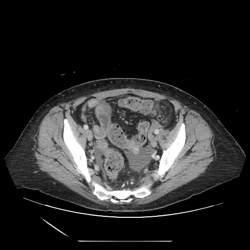 Acinar cell carcinoma of the pancreas (Radiopaedia 75442-86669 Axial C+ portal venous phase 122).jpg