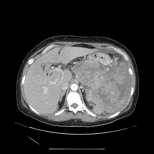 File:Acinar cell carcinoma of the pancreas (Radiopaedia 75442-86669 Axial C+ portal venous phase 36).jpg