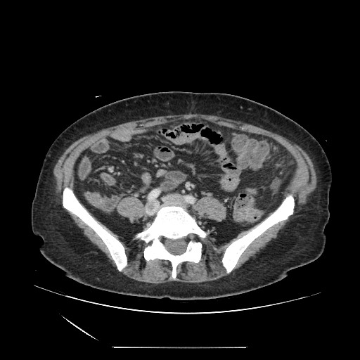 File:Acinar cell carcinoma of the pancreas (Radiopaedia 75442-86669 Axial C+ portal venous phase 98).jpg
