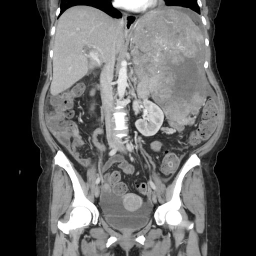 Acinar cell carcinoma of the pancreas (Radiopaedia 75442-86669 Coronal C+ portal venous phase 66).jpg