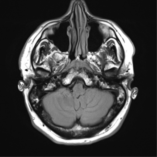 File:Acoustic schwannoma (Radiopaedia 50846-56358 Axial FLAIR 6).png