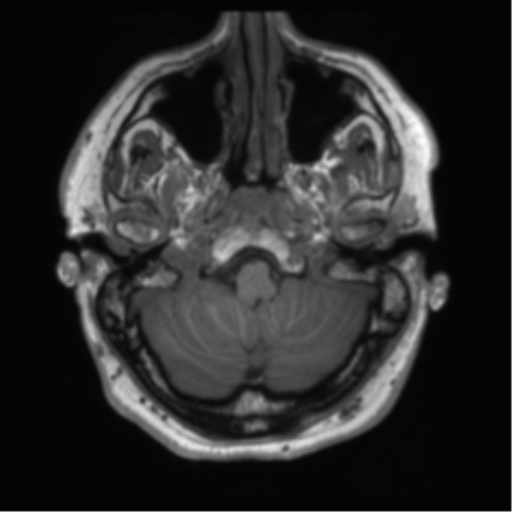 File:Acoustic schwannoma (Radiopaedia 50846-56358 Axial T1 6).png