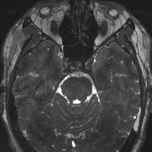 Acoustic schwannoma (translabyrinthine resection) (Radiopaedia 43570-46972 Axial CISS 49).png