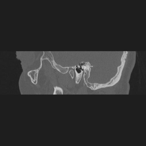 File:Acoustic schwannoma - cystic (Radiopaedia 29487-29980 AXIAL RIGHT bone window 1).jpg