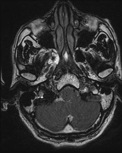 Acoustic schwannoma - probable (Radiopaedia 20386-20292 Axial T1 23).jpg
