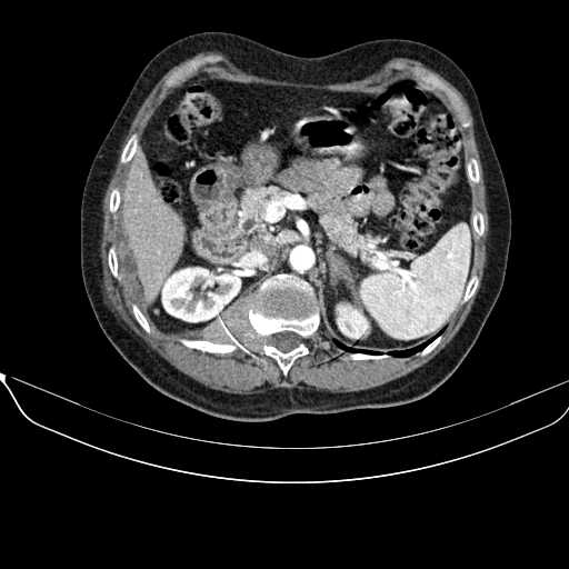 File:Acquired adrenal hyperplasia - due to thymic carcinoid tumor (Radiopaedia 21269-21184 C+ arterial phase 37).jpg